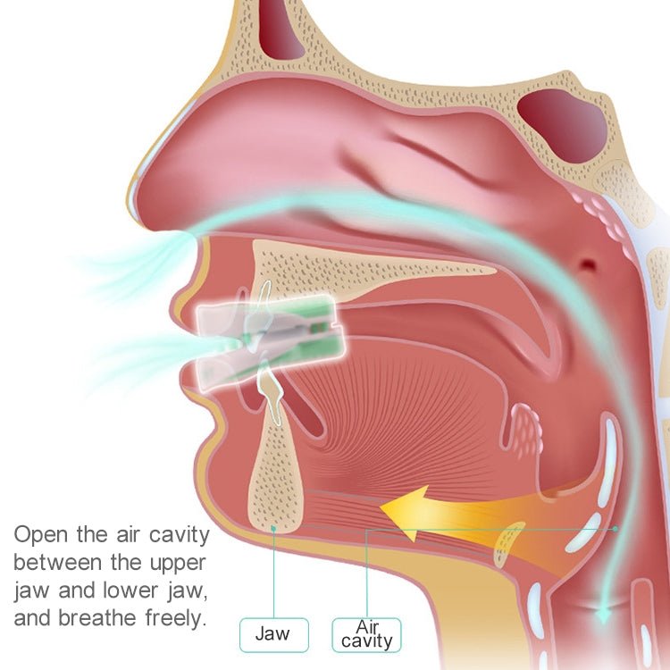 Yuknight Adult Home Throat Anti-snoring Mouthguard Device - Eurekaonline